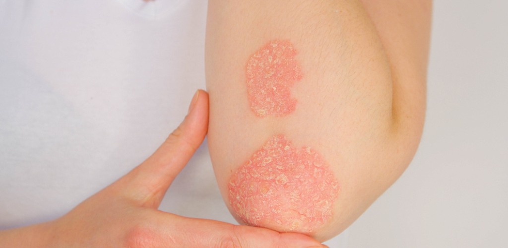 Psoriasis Ayurvedic Treatment